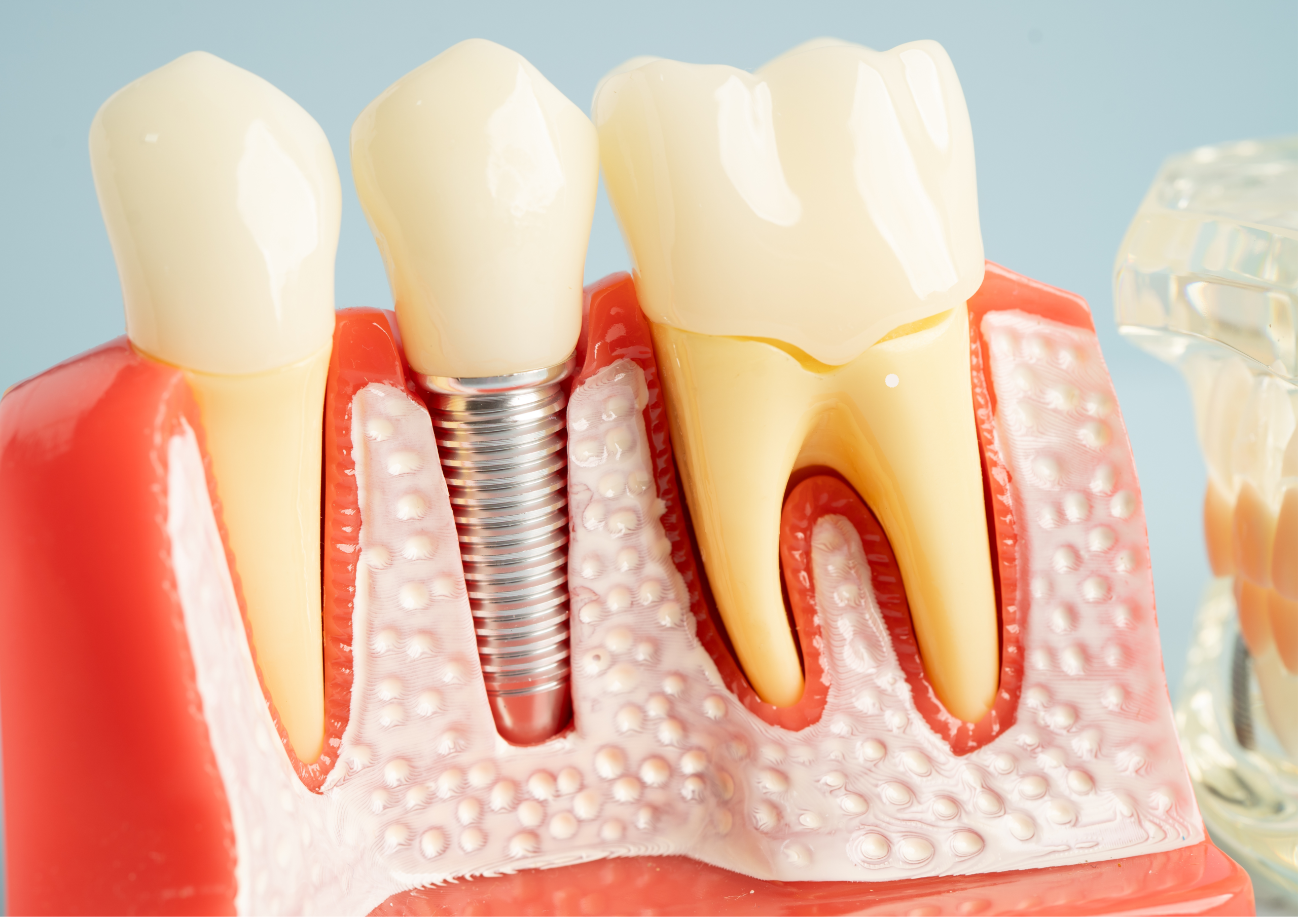 Implantologie Dentara Lemon Dent